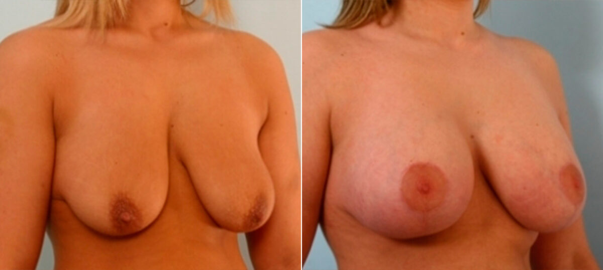 Breast Augmentation-Mastopexy before and after photos in Houston, TX, Patient 27368