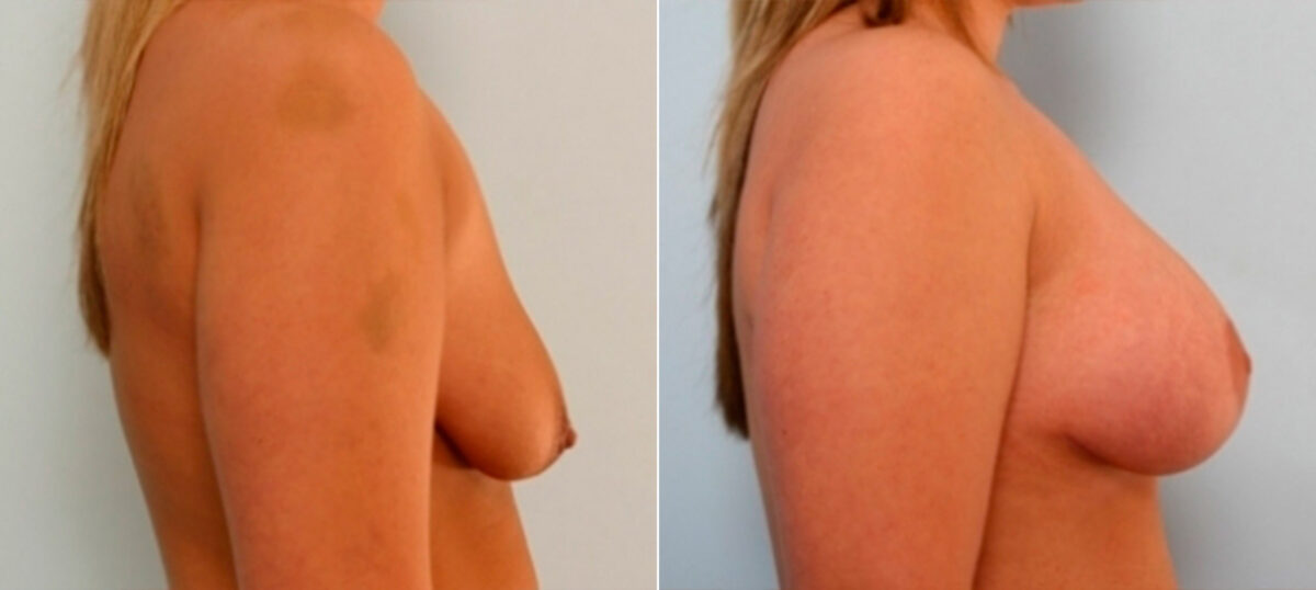 Breast Augmentation-Mastopexy before and after photos in Houston, TX, Patient 27368