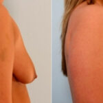 Breast Augmentation-Mastopexy before and after photos in Houston, TX, Patient 27368