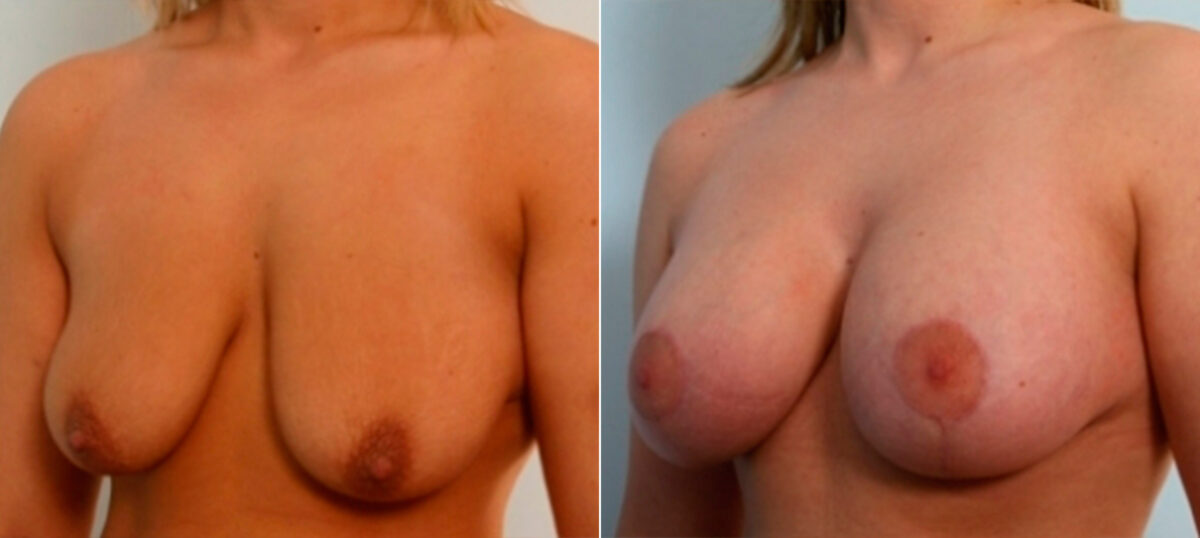 Breast Augmentation-Mastopexy before and after photos in Houston, TX, Patient 27368