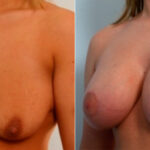 Breast Augmentation-Mastopexy before and after photos in Houston, TX, Patient 27368