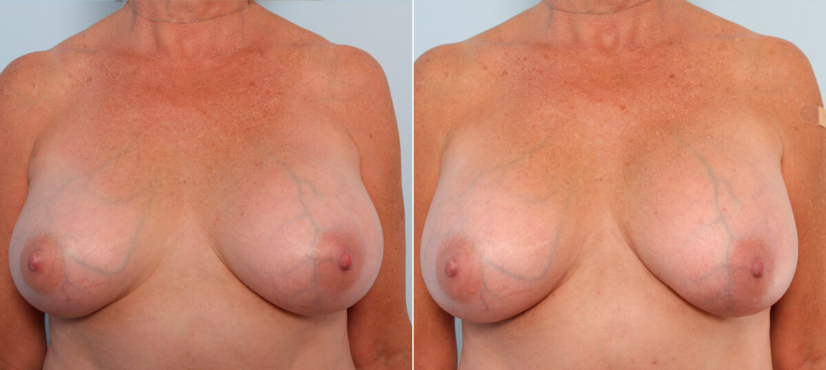 Breast Implant Exchange before and after photos in Houston, TX, Patient 27377