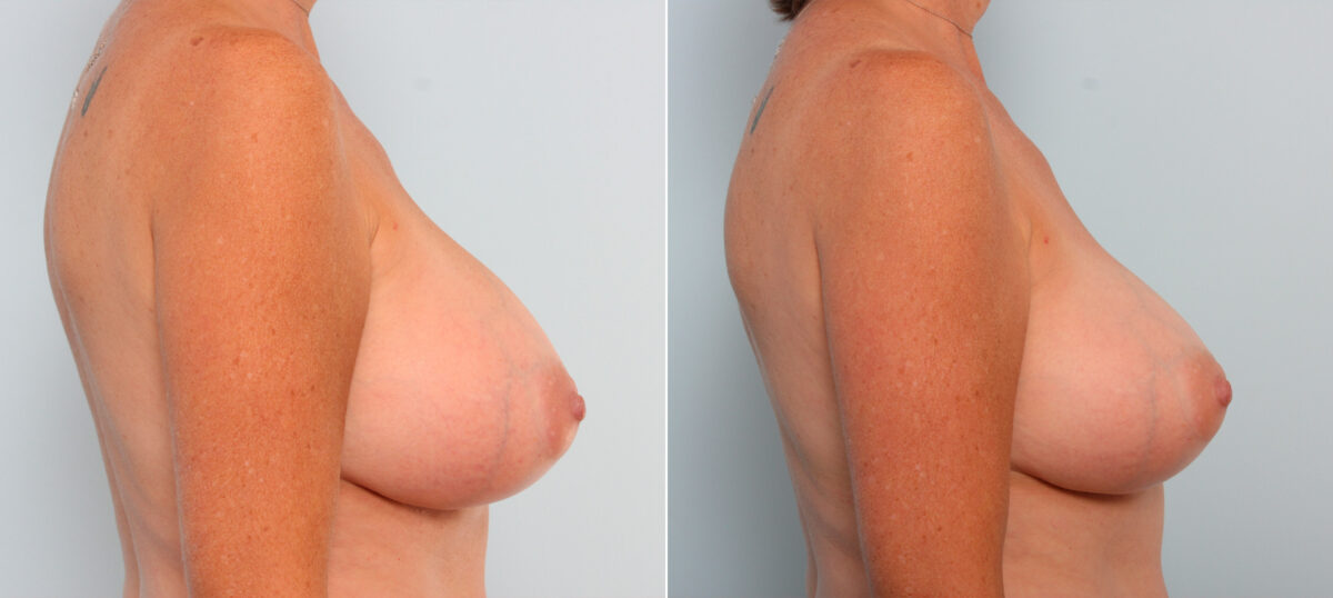 Breast Implant Exchange before and after photos in Houston, TX, Patient 27377