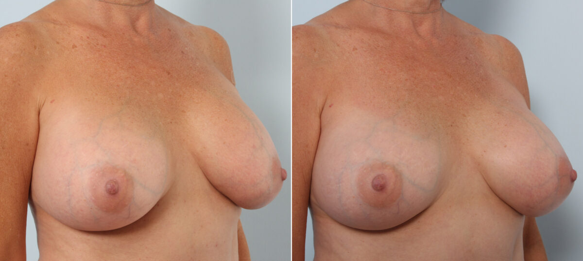 Breast Implant Exchange before and after photos in Houston, TX, Patient 27377