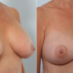 Breast Implant Exchange before and after photos in Houston, TX, Patient 27377