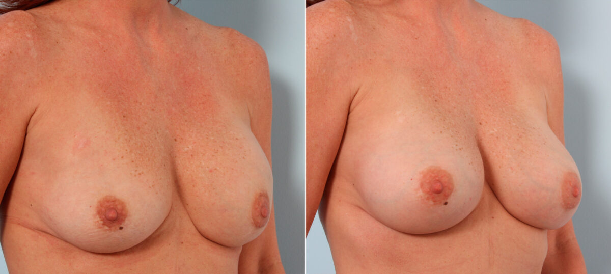 Breast Implant Exchange before and after photos in Houston, TX, Patient 27380
