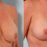 Breast Implant Exchange before and after photos in Houston, TX, Patient 27380