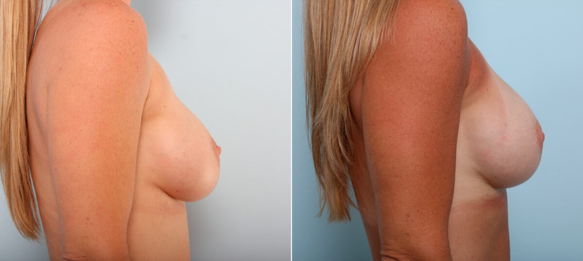 Breast Implant Exchange before and after photos in Houston, TX, Patient 27383