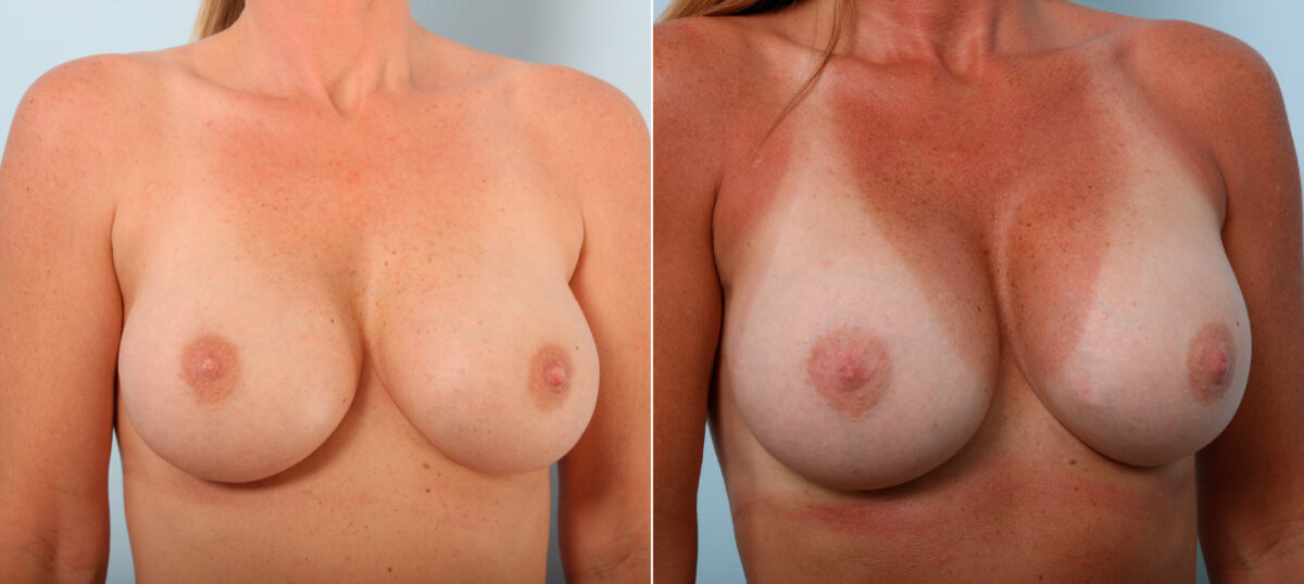 Breast Implant Exchange before and after photos in Houston, TX, Patient 27383