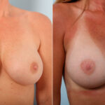 Breast Implant Exchange before and after photos in Houston, TX, Patient 27383