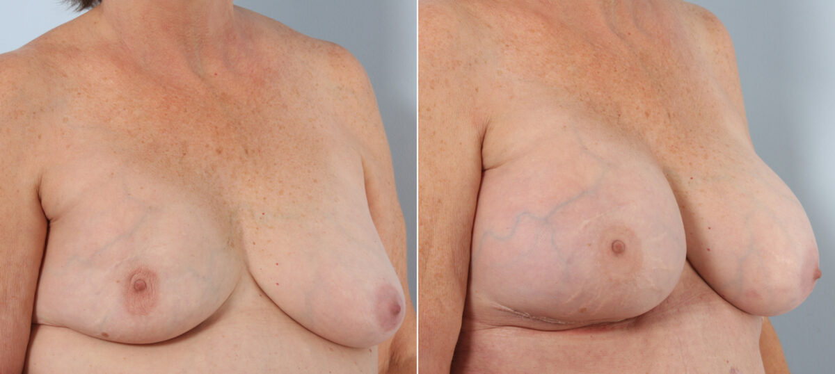 Breast Implant Exchange before and after photos in Houston, TX, Patient 27386
