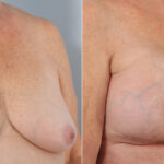 Breast Implant Exchange before and after photos in Houston, TX, Patient 27386