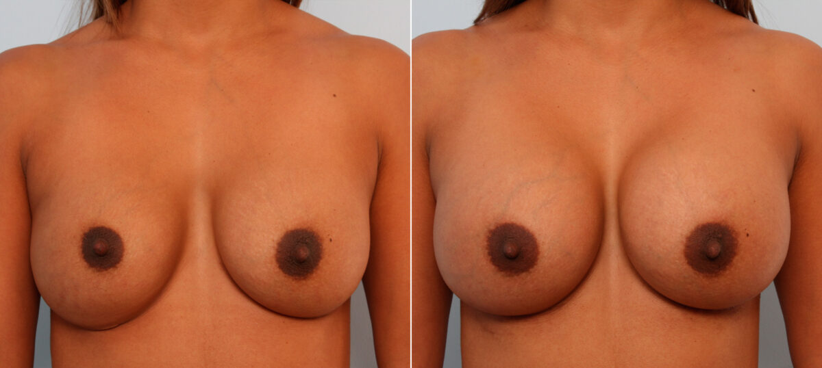 Breast Implant Exchange before and after photos in Houston, TX, Patient 27389