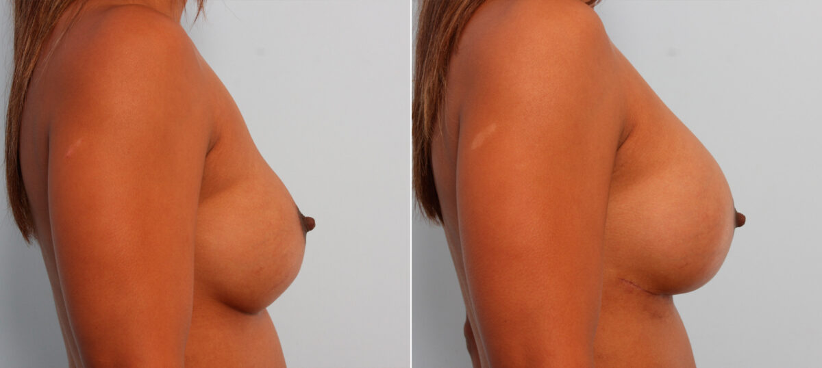 Breast Implant Exchange before and after photos in Houston, TX, Patient 27389
