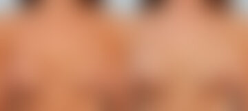 Breast Implant Exchange before and after photos in Houston, TX, Patient 27392