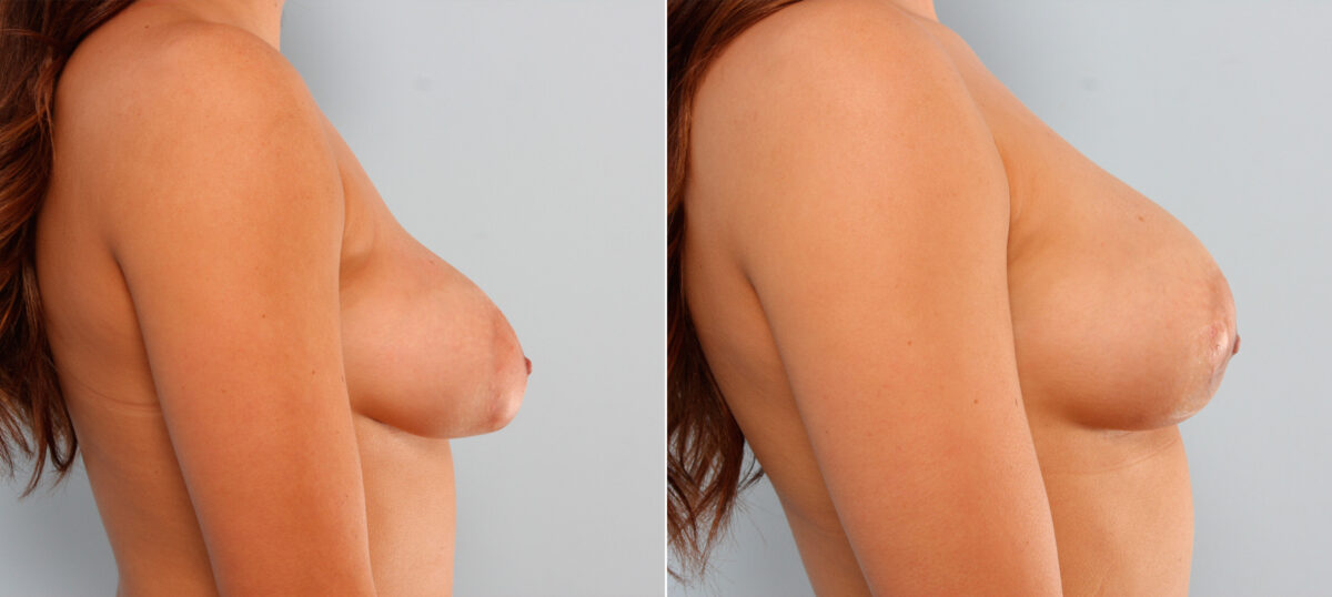Breast Implant Exchange before and after photos in Houston, TX, Patient 27392