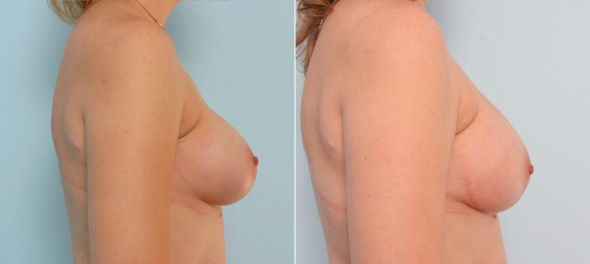 Breast Implant Exchange before and after photos in Houston, TX, Patient 27395