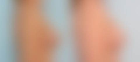 Breast Implant Exchange before and after photos in Houston, TX, Patient 27395