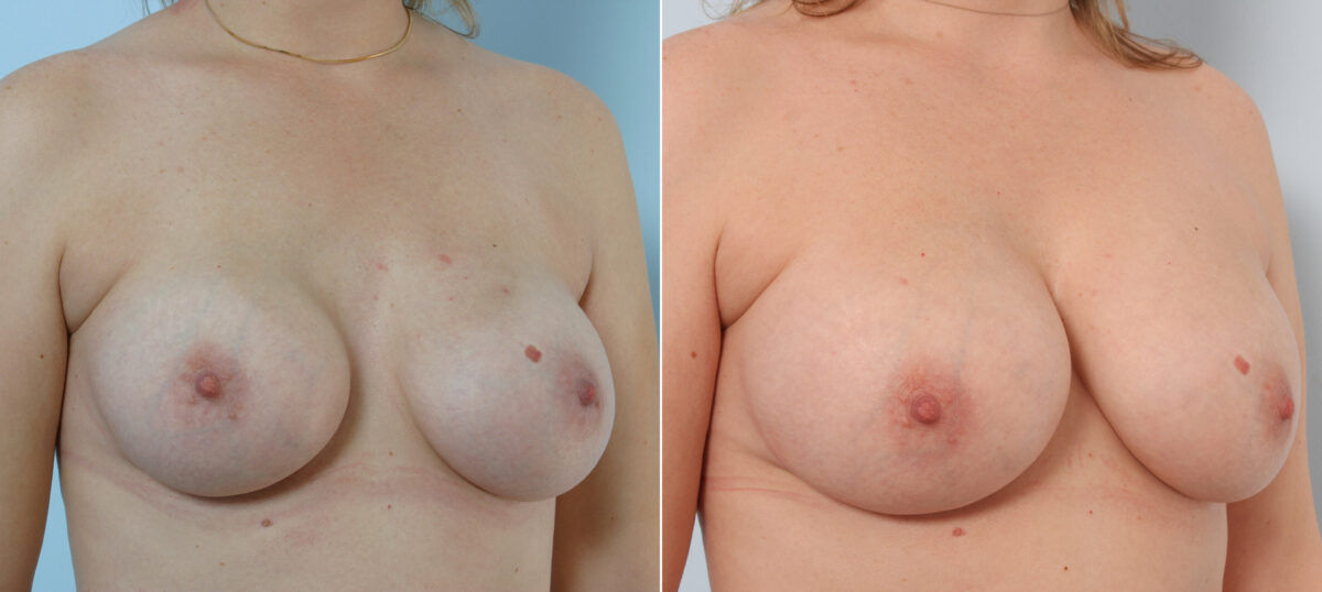Breast Implant Exchange before and after photos in Houston, TX, Patient 27395
