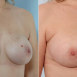 Breast Implant Exchange before and after photos in Houston, TX, Patient 27395