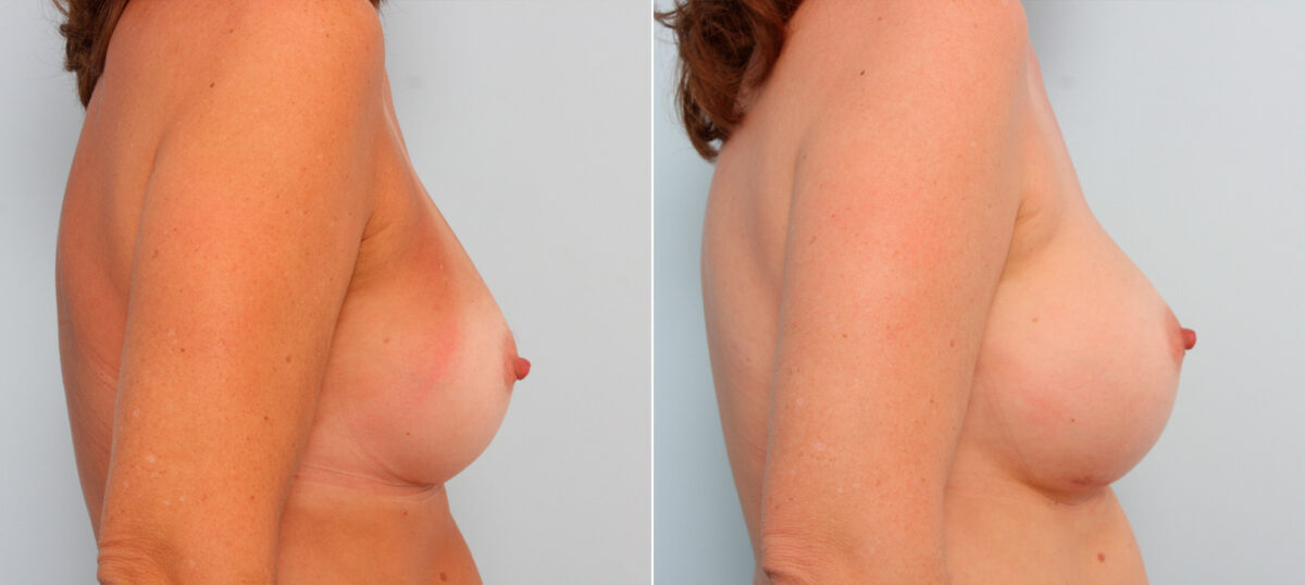 Breast Implant Exchange before and after photos in Houston, TX, Patient 27398