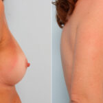 Breast Implant Exchange before and after photos in Houston, TX, Patient 27398
