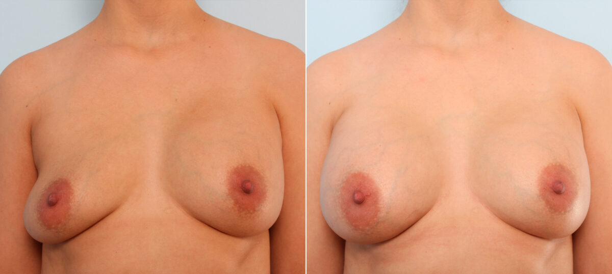 Breast Implant Exchange before and after photos in Houston, TX, Patient 27401