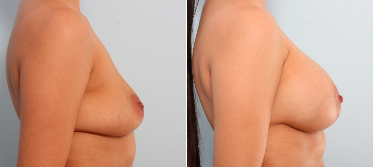 Breast Implant Exchange before and after photos in Houston, TX, Patient 27401