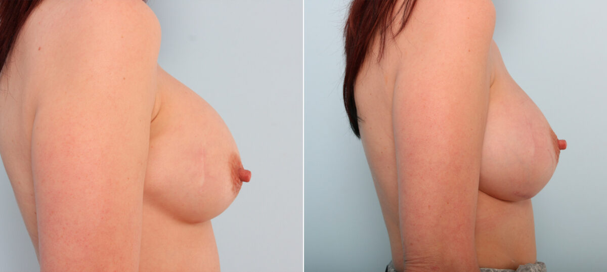 Breast Implant Exchange before and after photos in Houston, TX, Patient 27404
