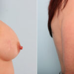 Breast Implant Exchange before and after photos in Houston, TX, Patient 27404