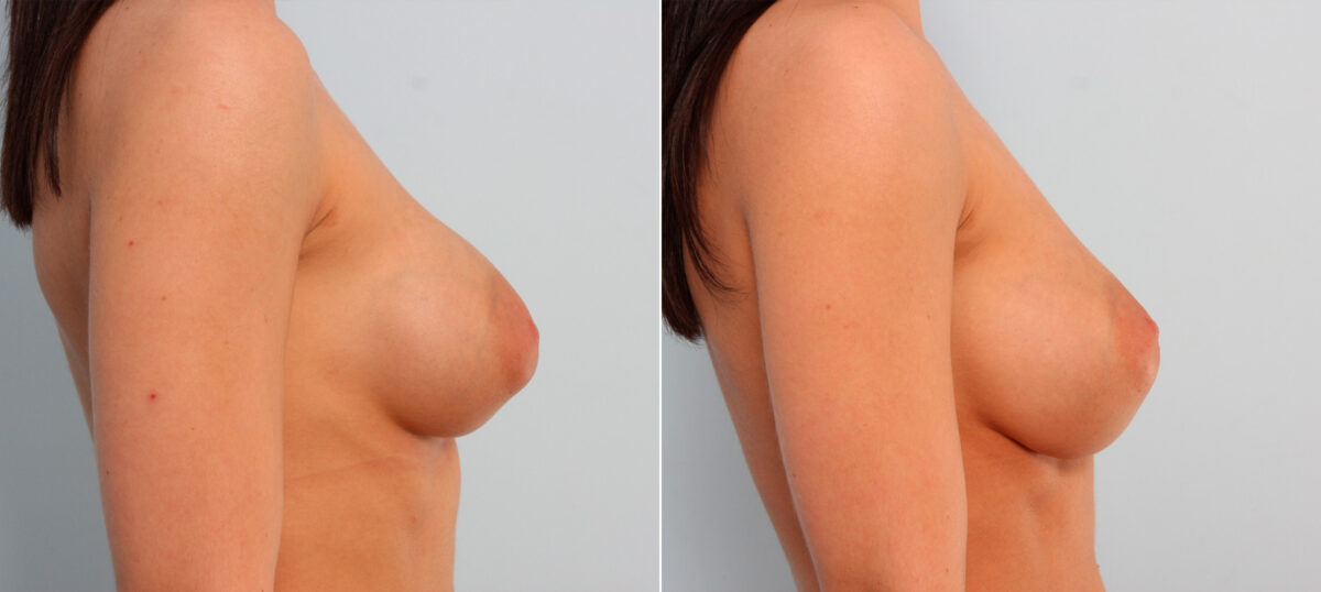 Breast Implant Exchange before and after photos in Houston, TX, Patient 27407