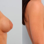 Breast Implant Exchange before and after photos in Houston, TX, Patient 27407