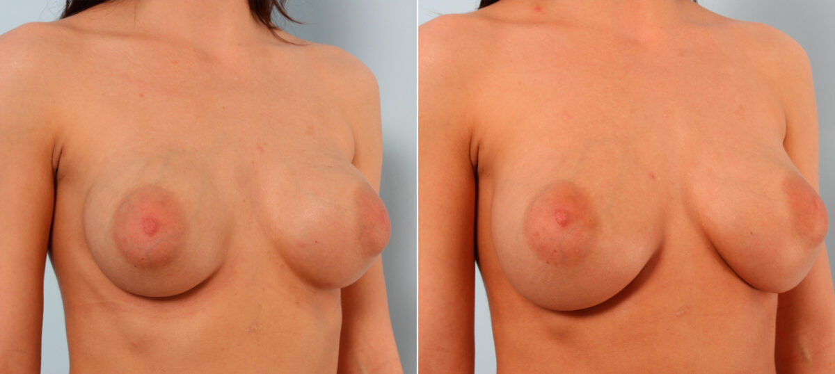 Breast Implant Exchange before and after photos in Houston, TX, Patient 27407