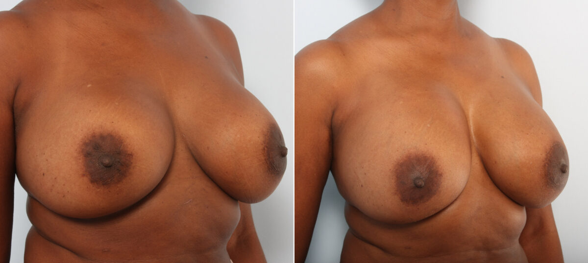 Breast Implant Exchange before and after photos in Houston, TX, Patient 27410