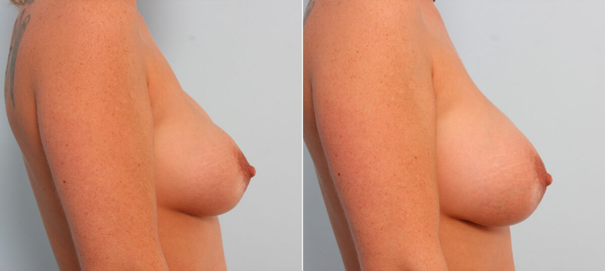 Breast Implant Exchange before and after photos in Houston, TX, Patient 27413