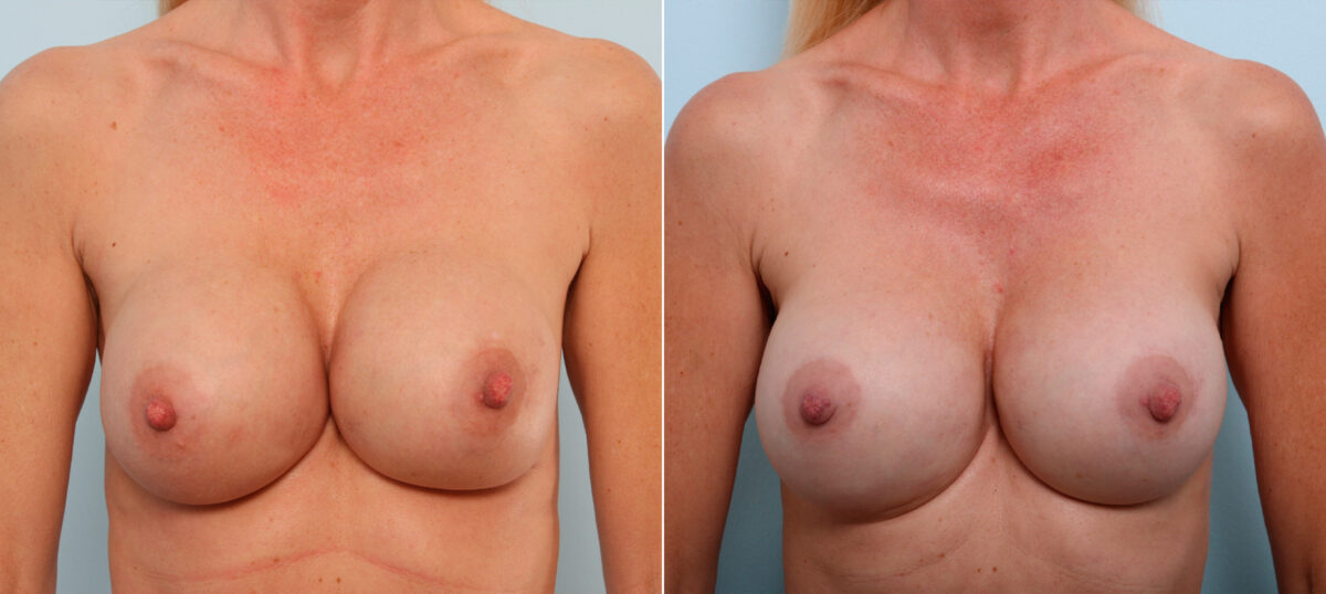Breast Implant Exchange before and after photos in Houston, TX, Patient 27416