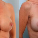 Breast Implant Exchange before and after photos in Houston, TX, Patient 27416