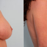 Breast Implant Exchange before and after photos in Houston, TX, Patient 27419