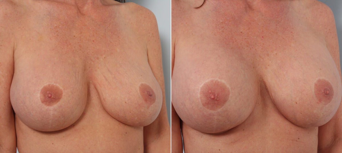 Breast Implant Exchange before and after photos in Houston, TX, Patient 27419