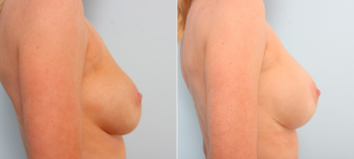 Breast Implant Exchange before and after photos in Houston, TX, Patient 27422