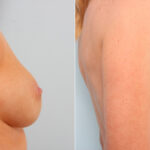 Breast Implant Exchange before and after photos in Houston, TX, Patient 27422