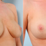 Breast Implant Exchange before and after photos in Houston, TX, Patient 27422