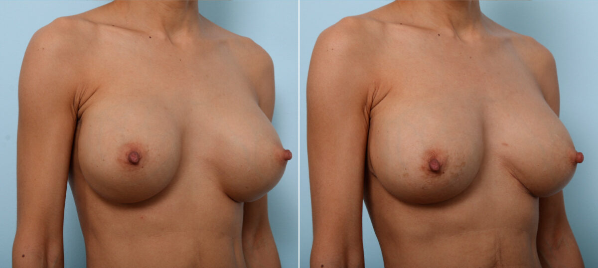Breast Implant Exchange before and after photos in Houston, TX, Patient 27425