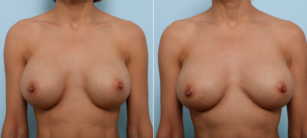 Breast Implant Exchange before and after photos in Houston, TX, Patient 27425