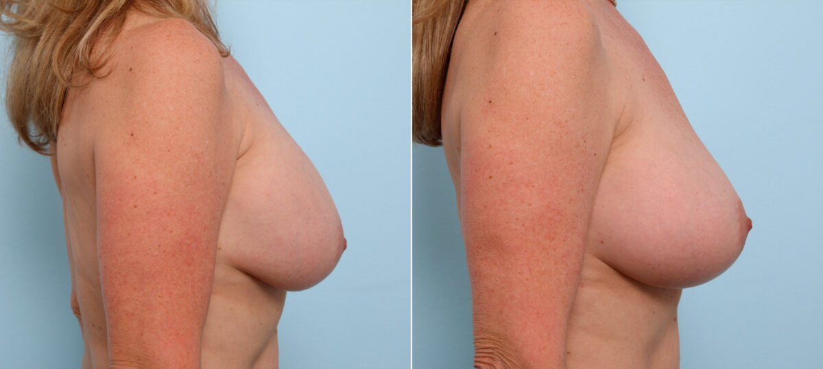 Breast Implant Exchange before and after photos in Houston, TX, Patient 27428