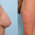 Breast Implant Exchange before and after photos in Houston, TX, Patient 27428