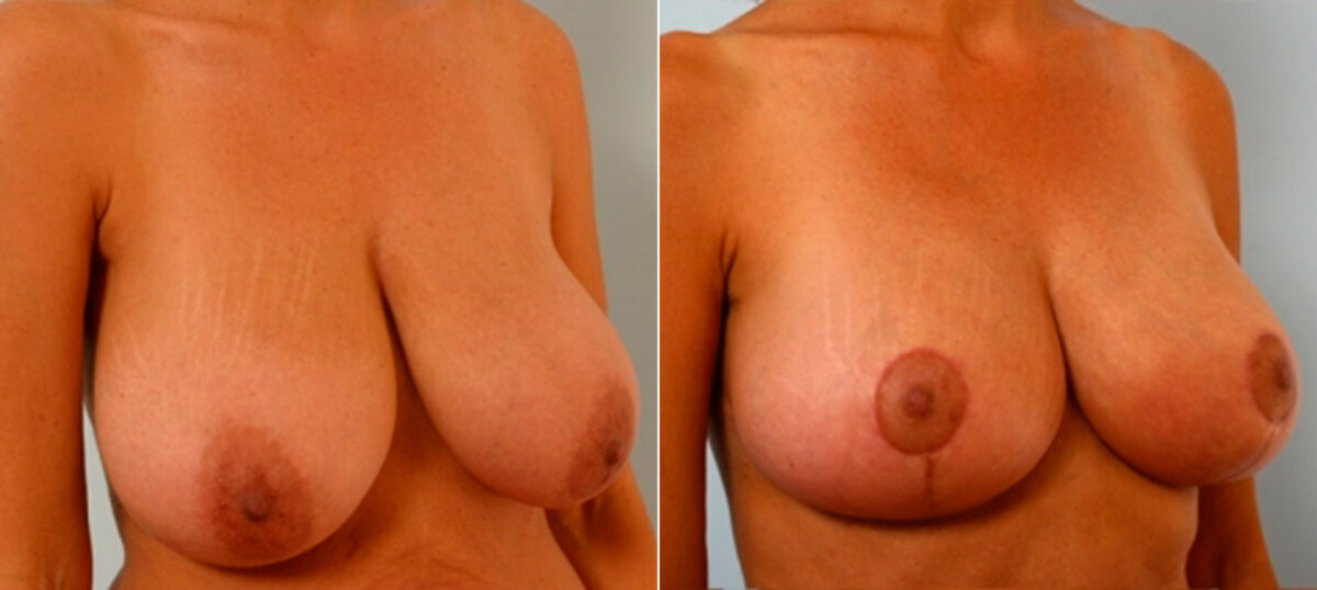 Breast Lift before and after photos in Houston, TX, Patient 27431