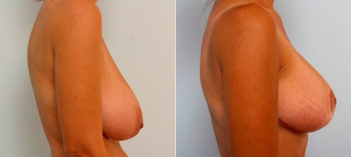 Breast Lift before and after photos in Houston, TX, Patient 27431