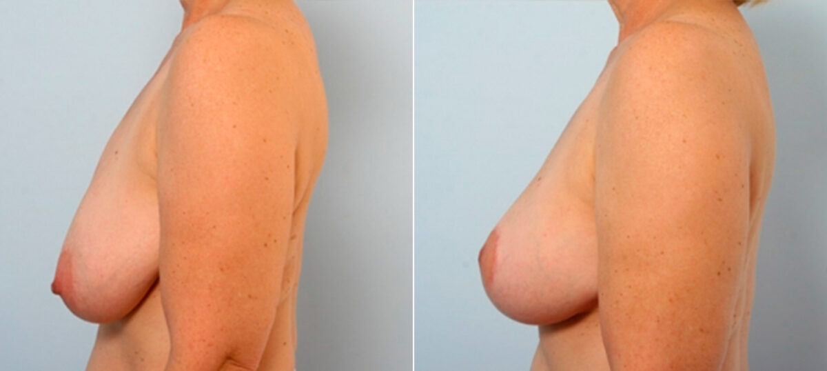 Breast Lift before and after photos in Houston, TX, Patient 27442