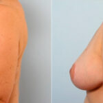 Breast Lift before and after photos in Houston, TX, Patient 27442